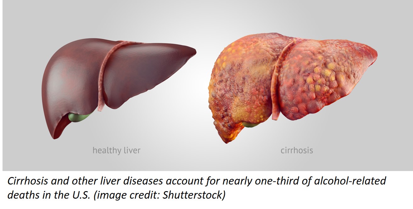 Two illustrations of the human liver. left: a healthy liver; right: a liver showing signs of cirrhosis